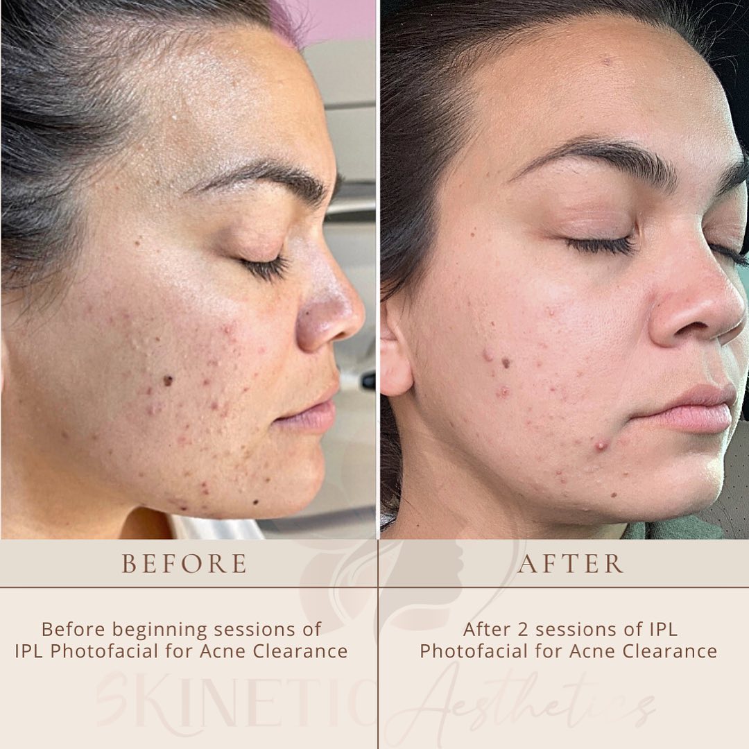 IPL photofacial for Acne Clearance in Las Vegas by Skinetic