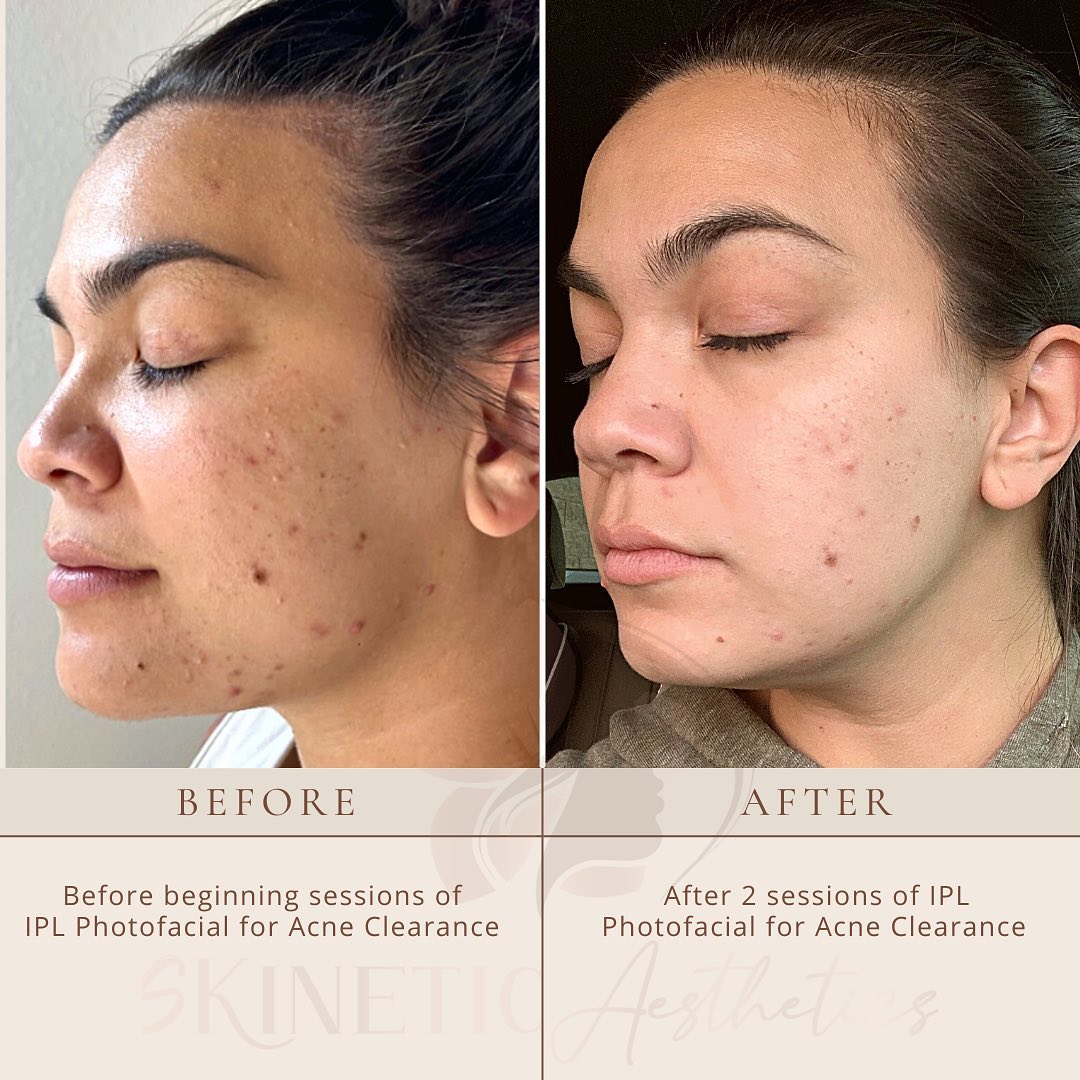 IPL photofacial for Acne Clearance in Las Vegas by Skinetic