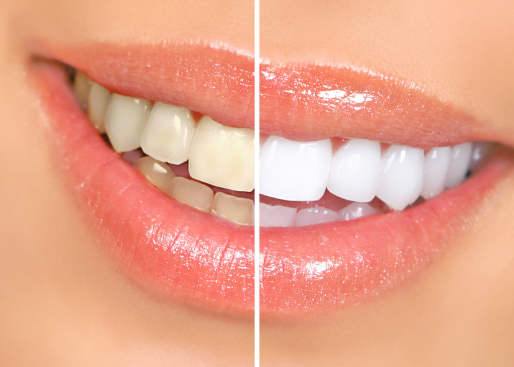 Does Activated Charcoal Whiten Teeth Is It Safe