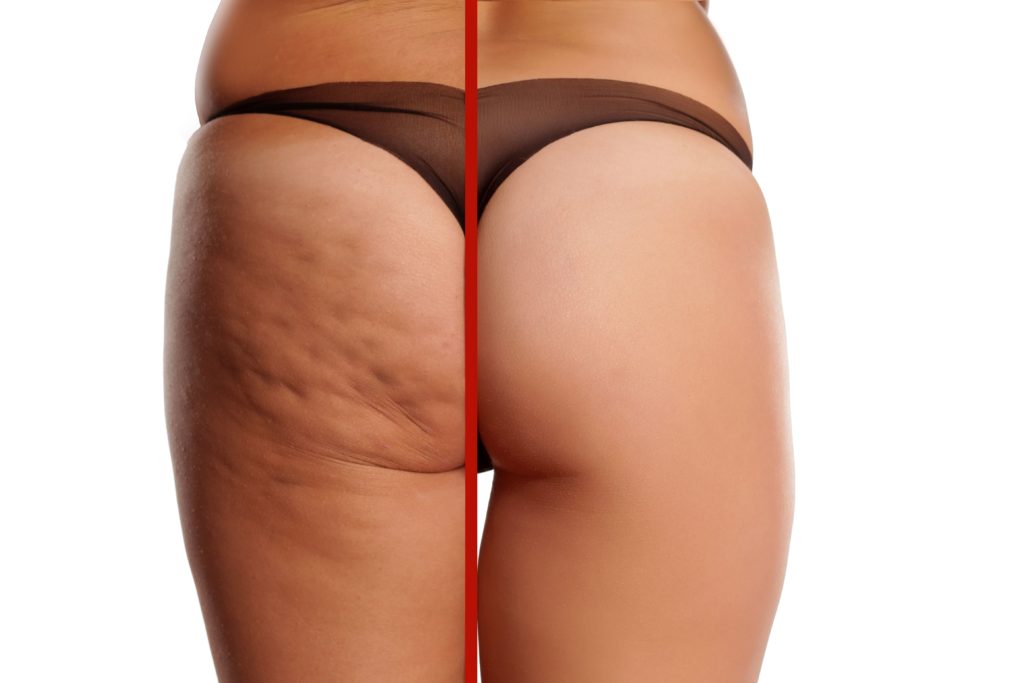 What is Cellulite Therapy?