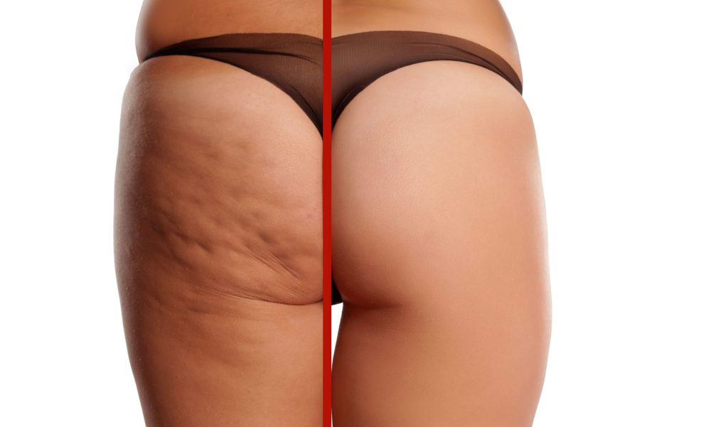 What is Cellulite Therapy?