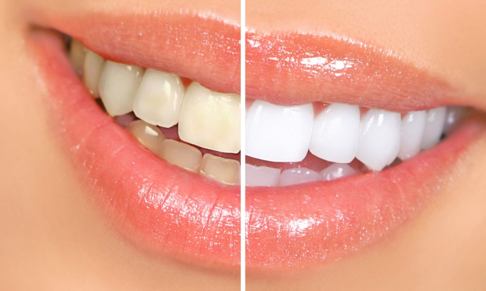 Does Activated Charcoal Whiten Teeth Is It Safe