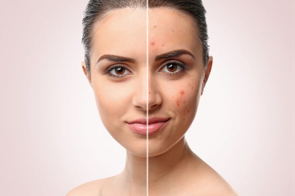 Luxe Facial for intensive acne free skin in Las Vegas by skinetic